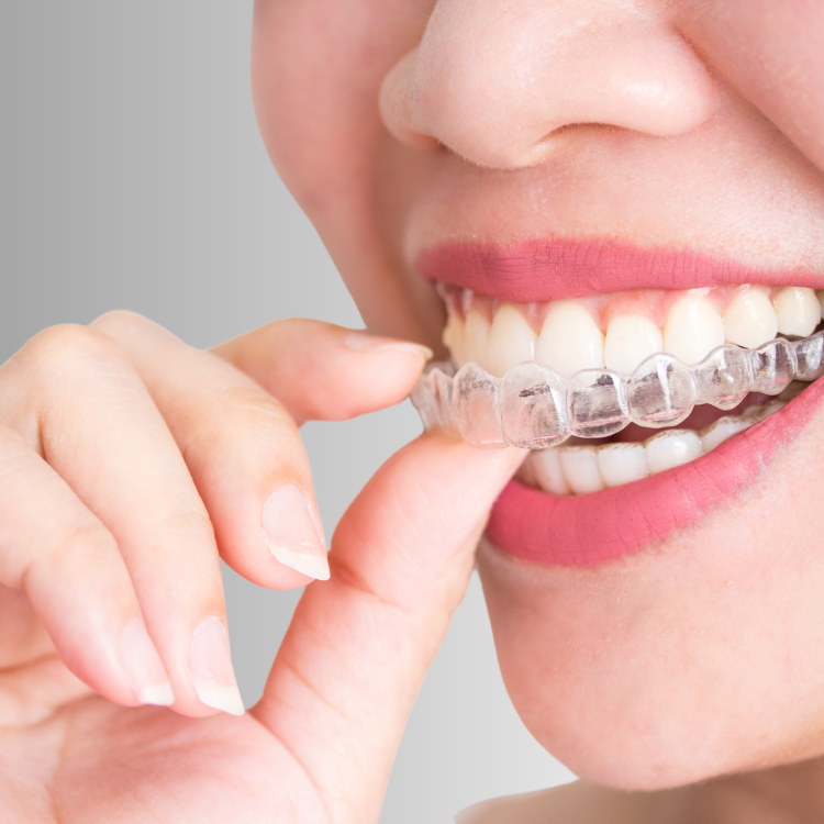 7 invisilign en boca de mujer con dentadura perfecta